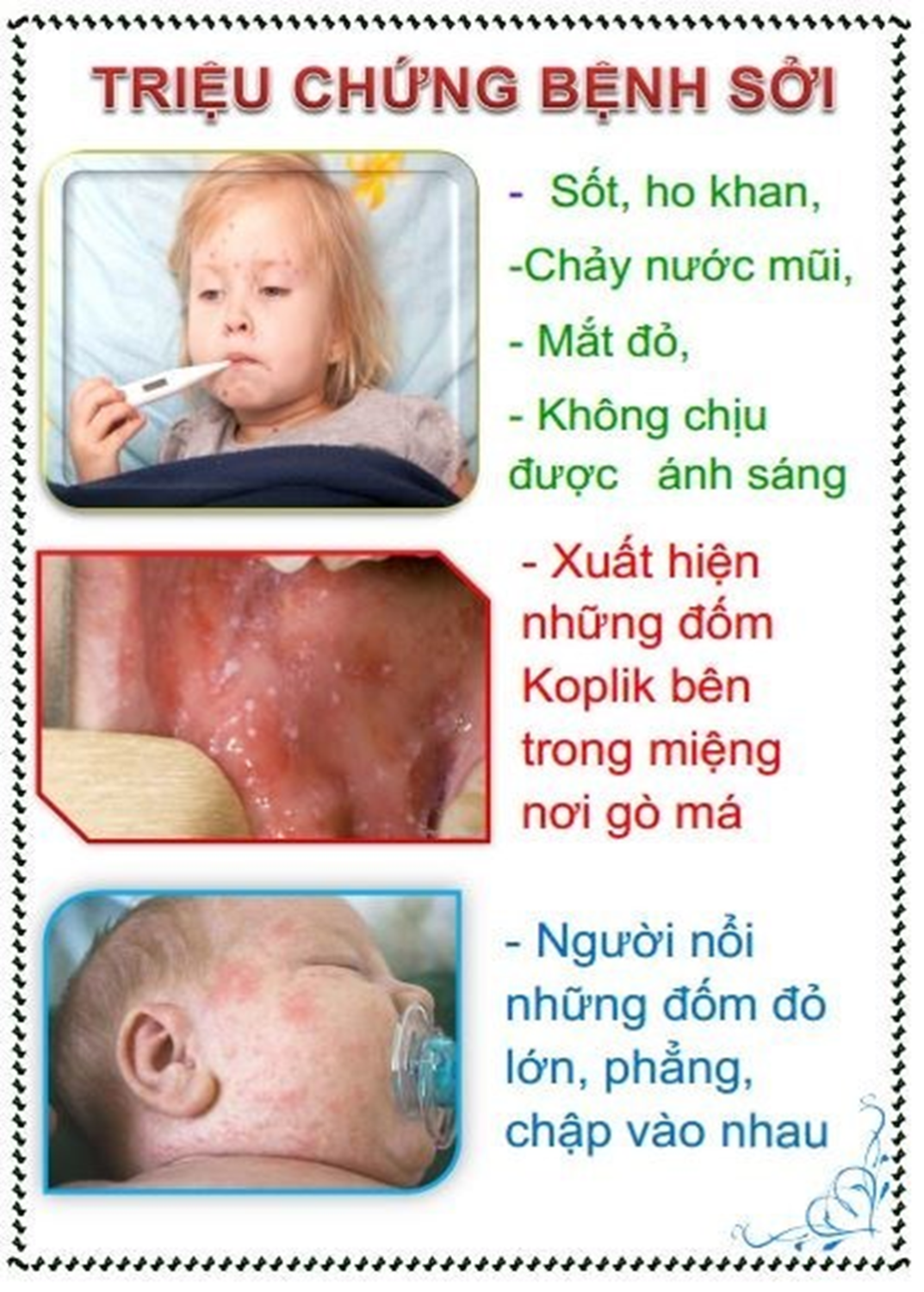 Các triệu chứng nhận biết, phòng và điều trị bệnh Sởi.